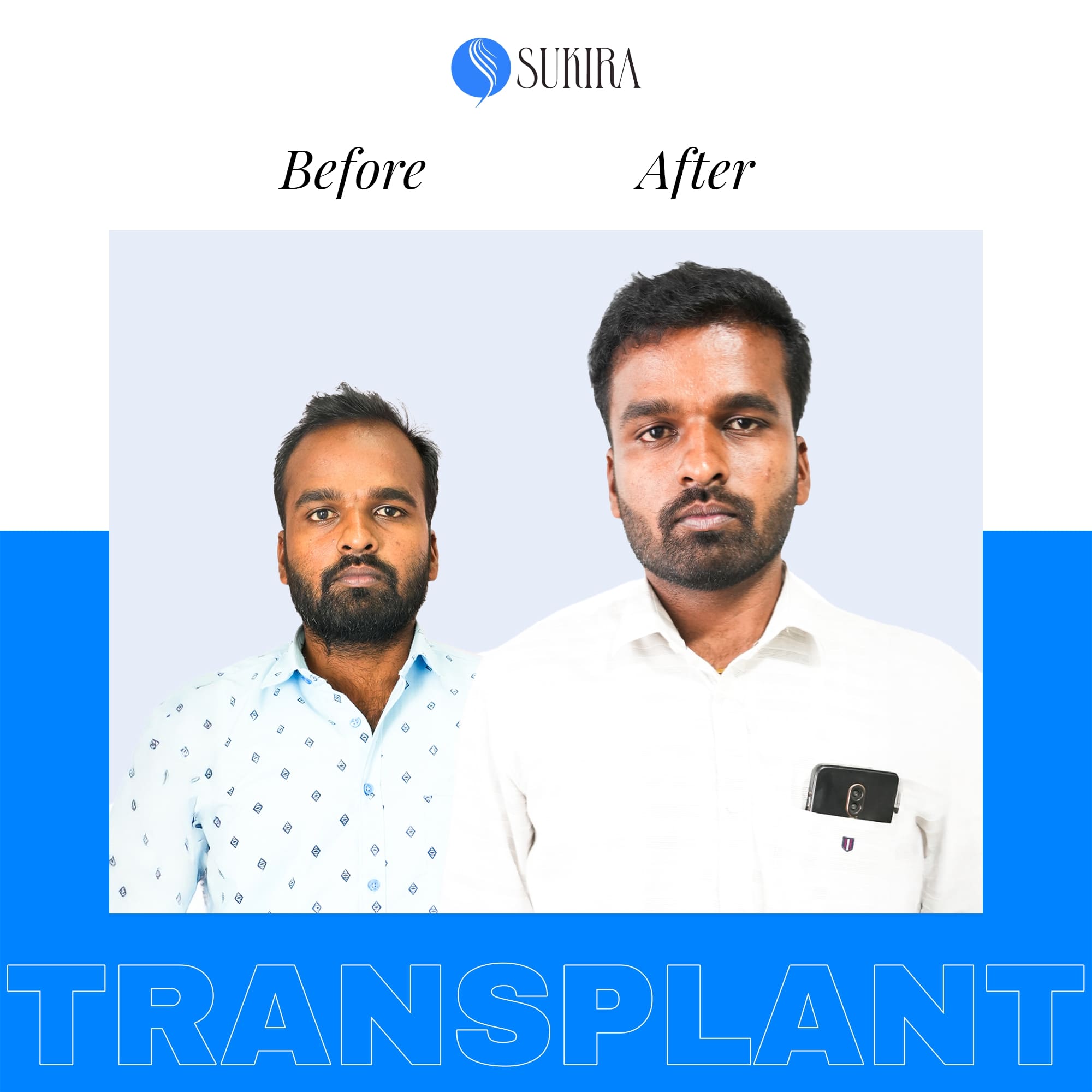 Hair Transplantation ba 1