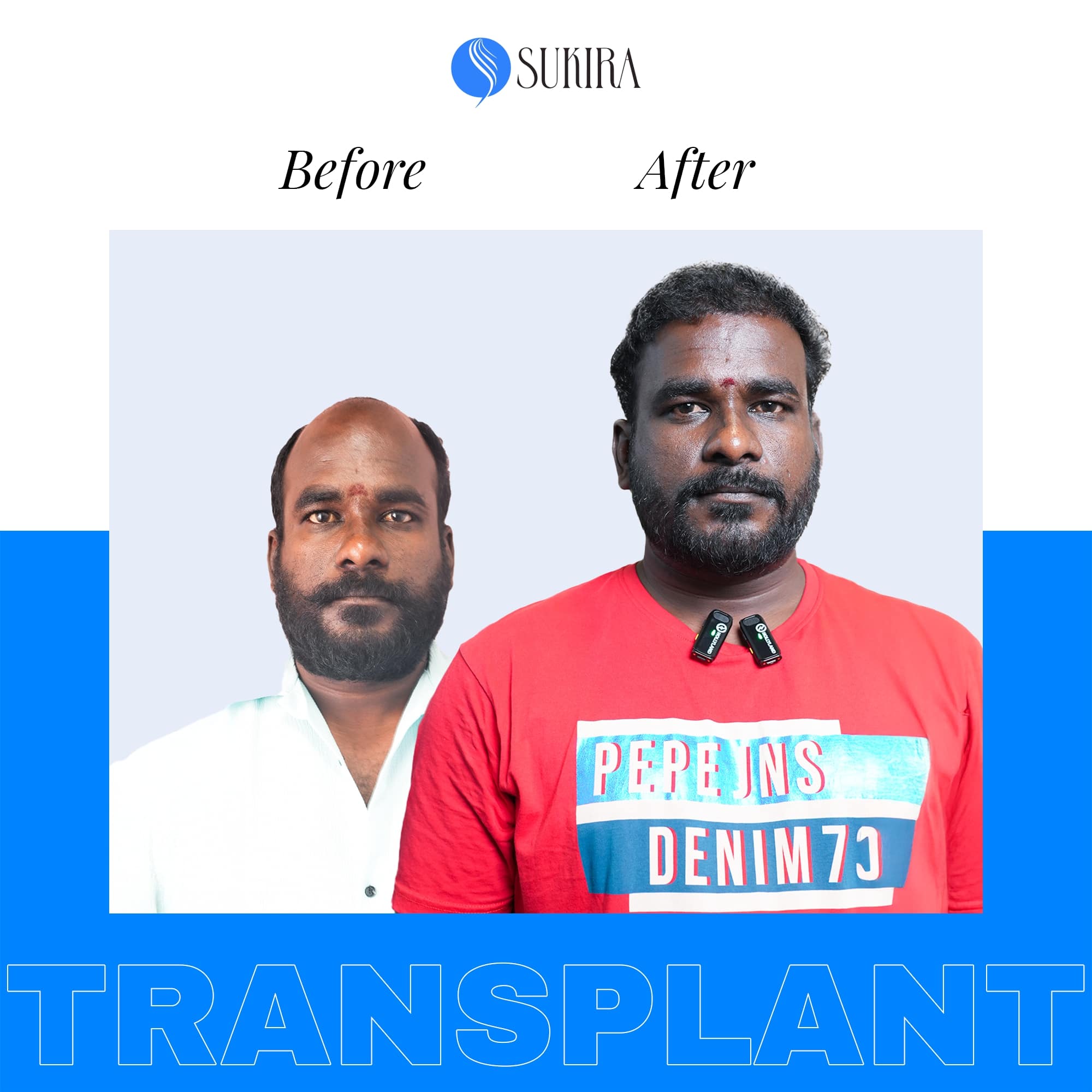 Hair Transplantation ba 2