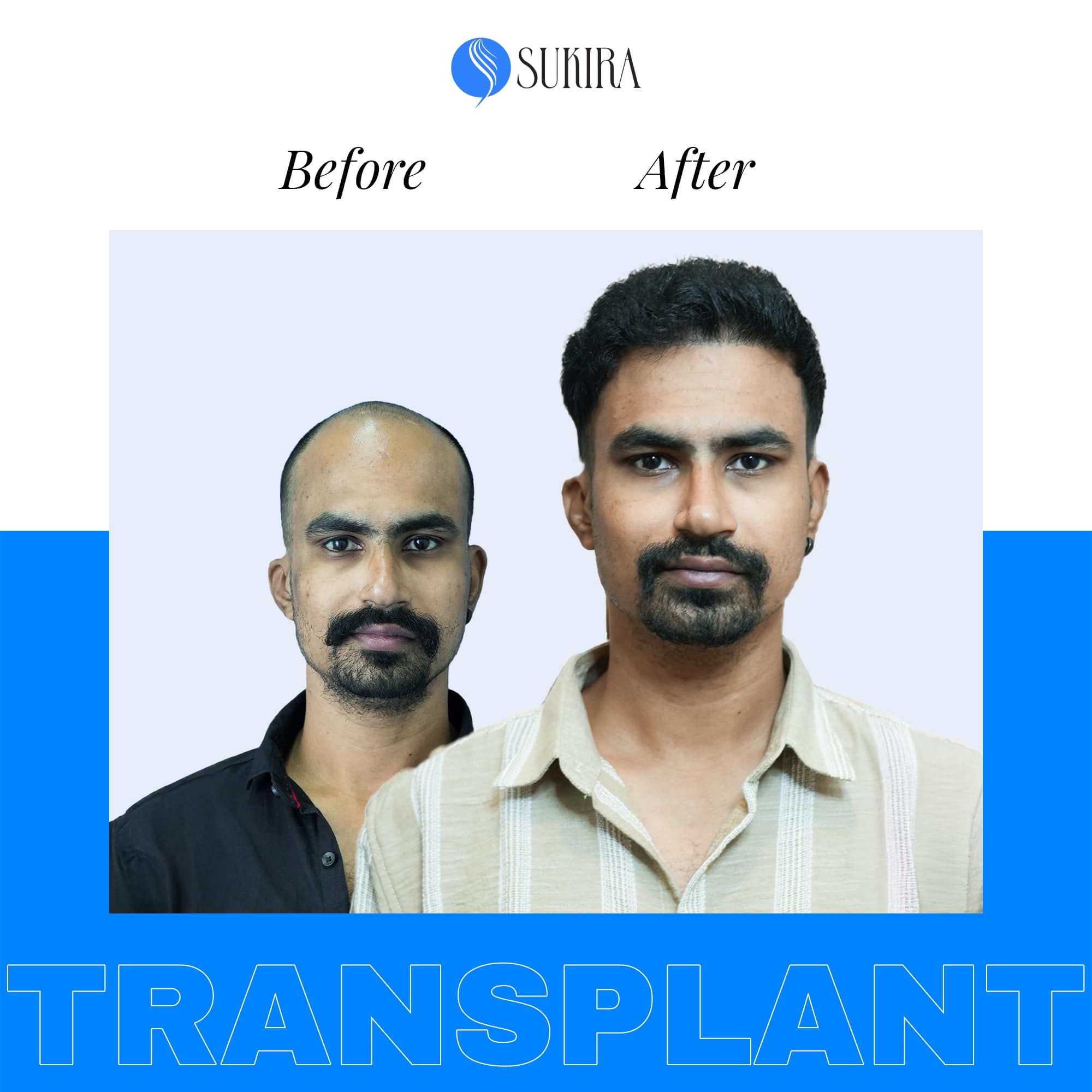 Hair Transplantation ba 3