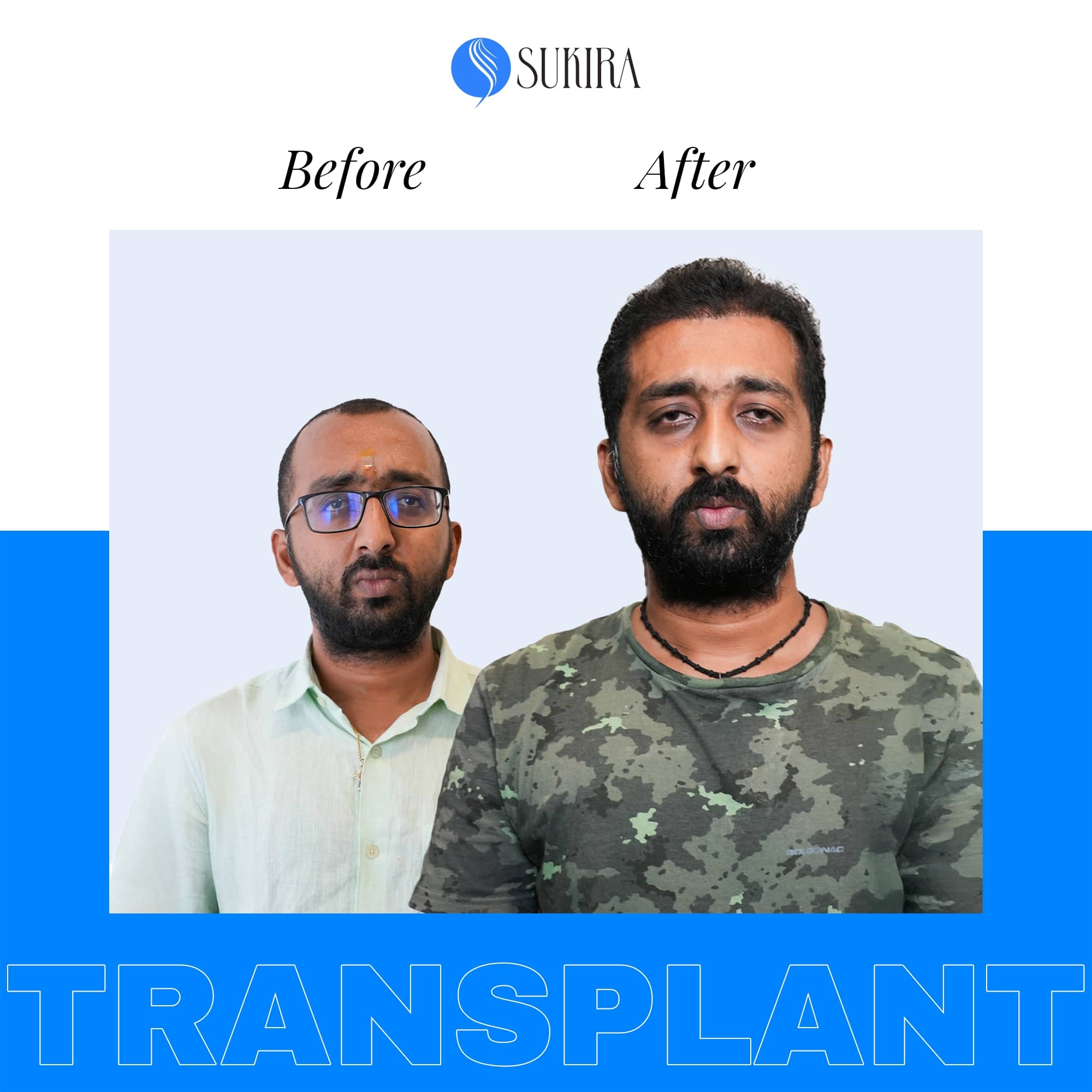Hair Transplantation ba 4