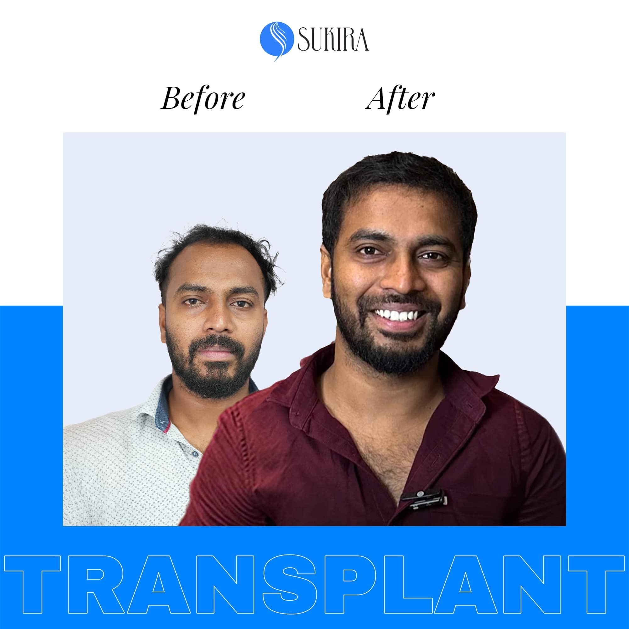 Hair Transplantation ba 5
