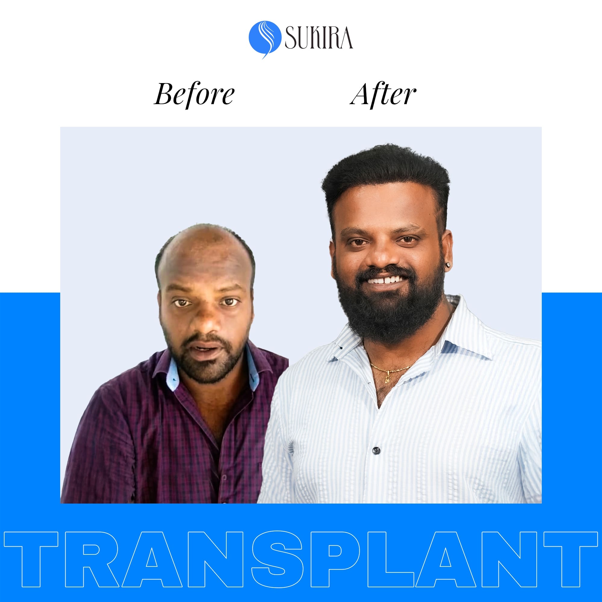 Hair Transplantation ba 6
