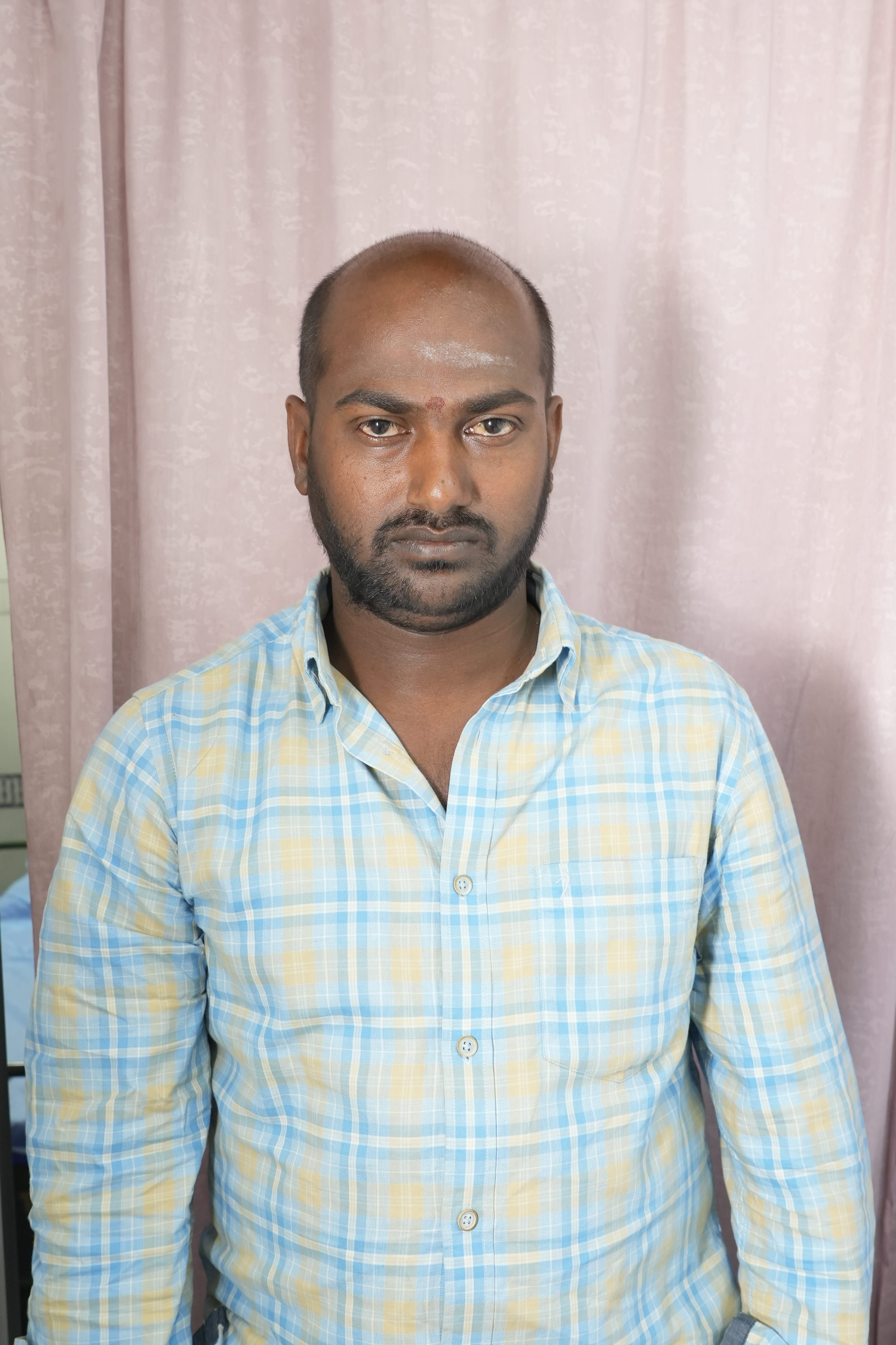 Before Hair Transplantation