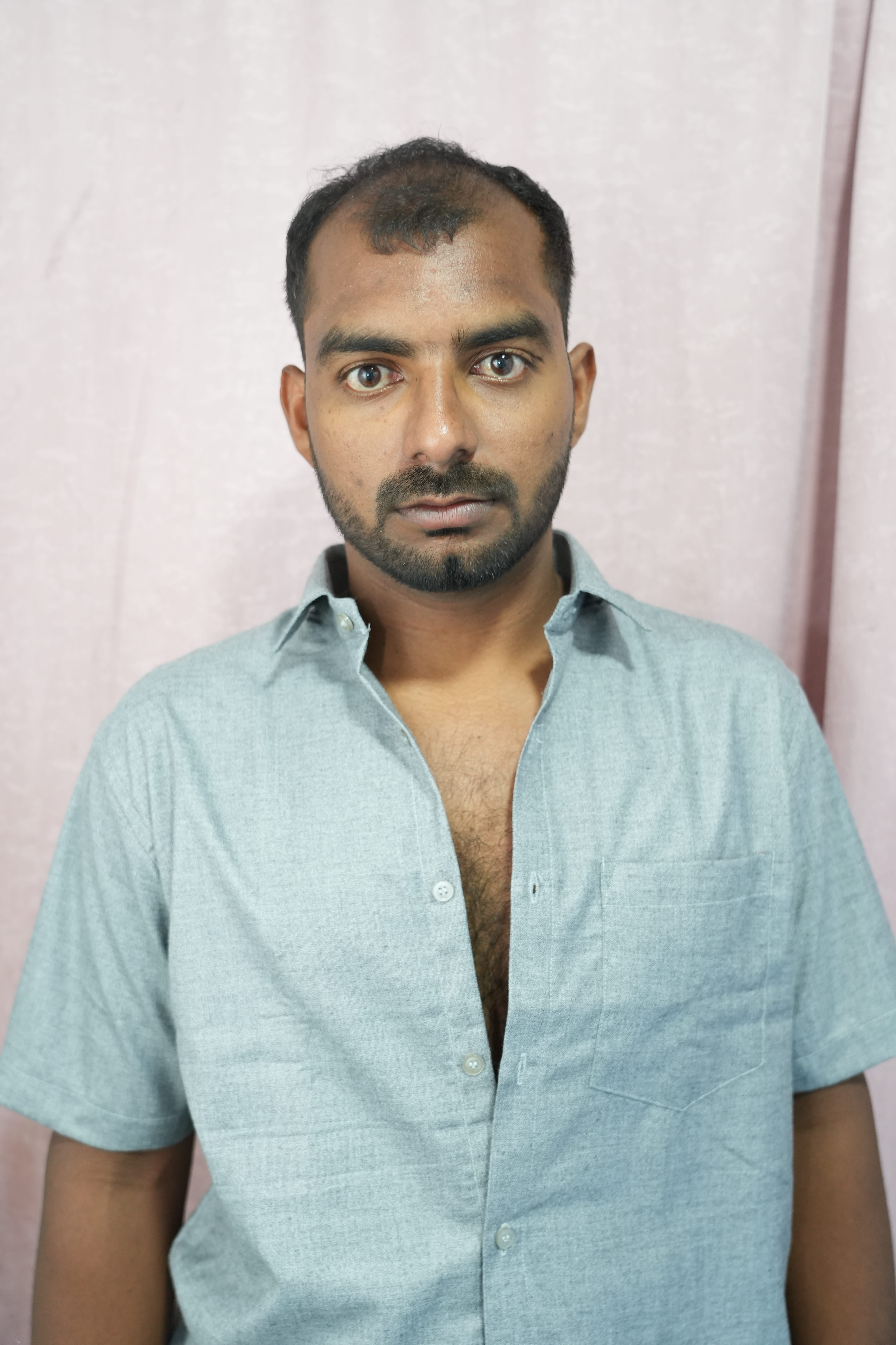 Before Beard Transplant