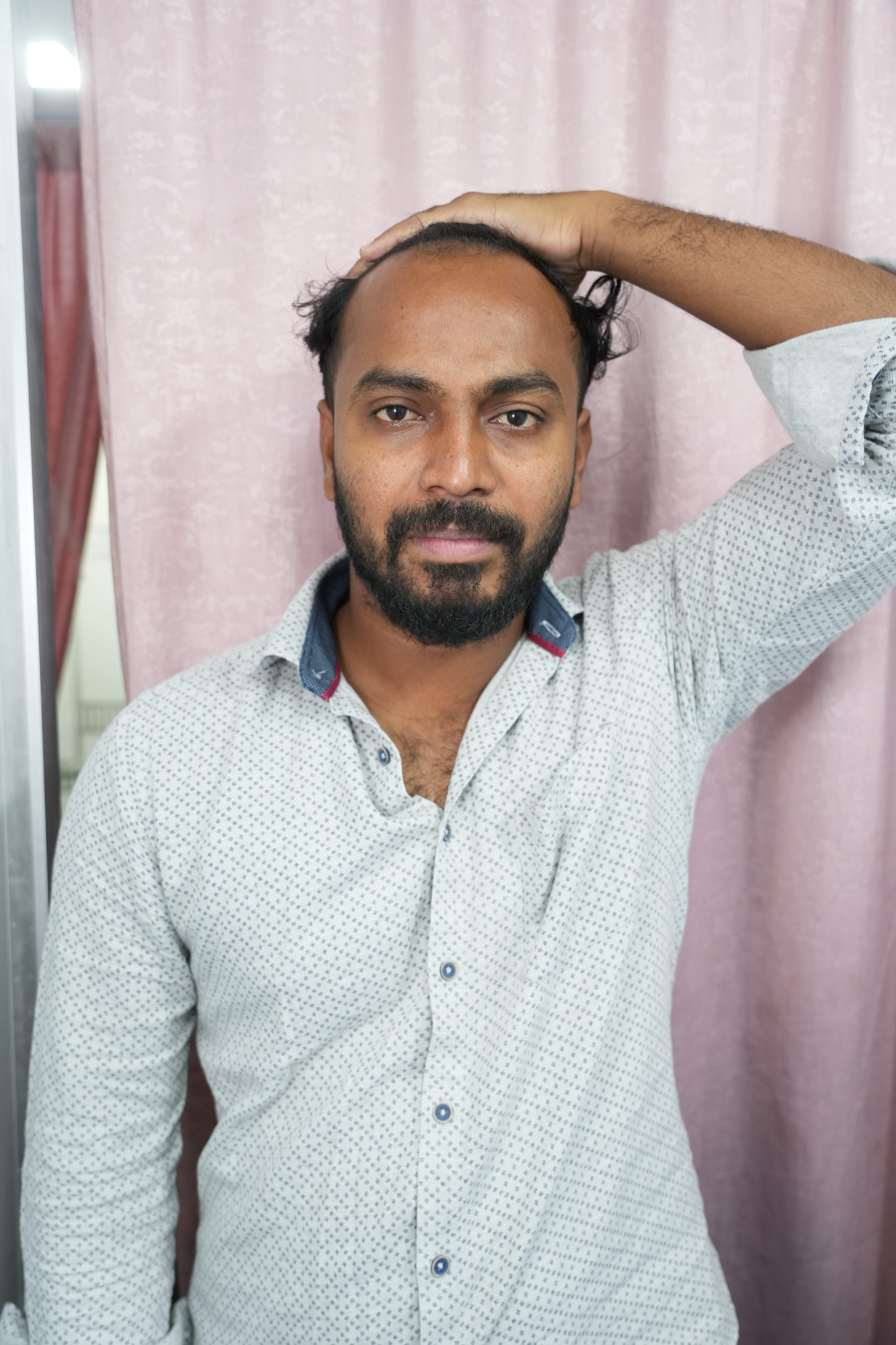 Before Hair Transplantation